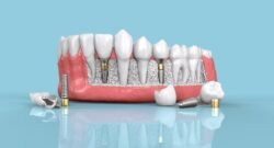 dental implant