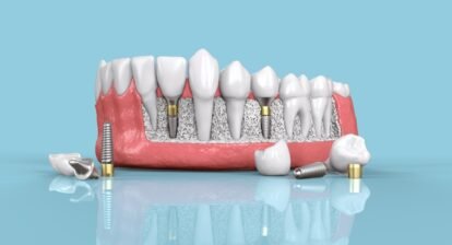 dental implant