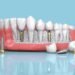 dental implant